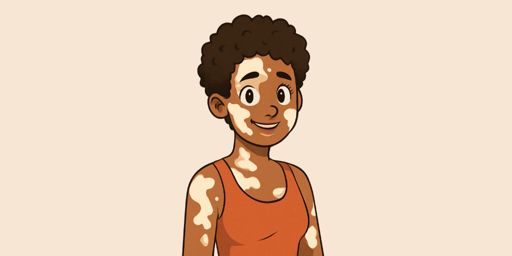Vitiligo 8 Vitiligo