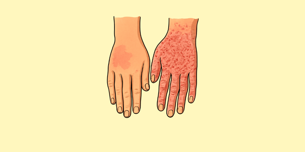 Eczema 8 Eczema