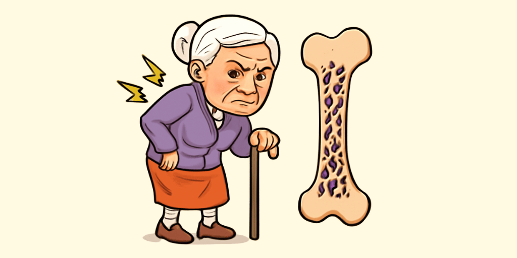 Osteoporosis 10 Osteoporosis